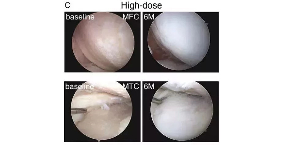 关节腔内干细胞注射