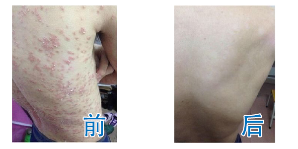 间充质干细胞疗法成功攻克困扰数十年的银屑病顽疾